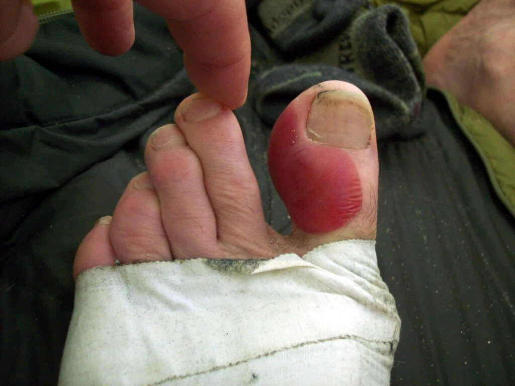 How to Prevent Blisters from Running