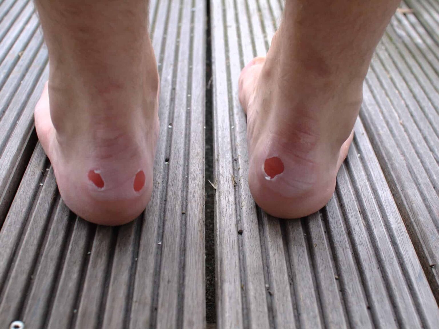 How To Prevent Blisters From Running | 10 Tips For Quick And Easy ...